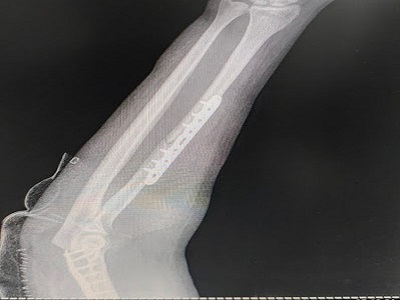 Fracture and Trauma Care